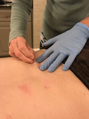 Dry Needling.