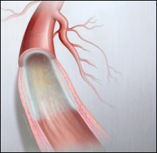 Peripheral Artery Disease Treatment