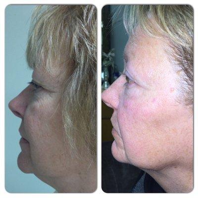 Noninvasive FaceLift with RF