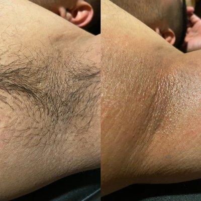 Before and after underarm wax