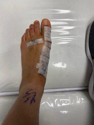 Progression check up after left foot bunion surgery (healing process)