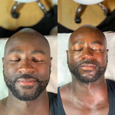 Signature Hydrofacial Before & After