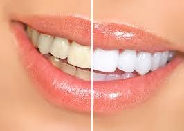 Professional Teeth Whitening in 30 minutes