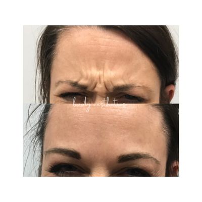 before and after wrinkle relaxer treatment!