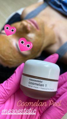 Cosmelan Peel for Melasma, Stubborn Hyperpigmentation