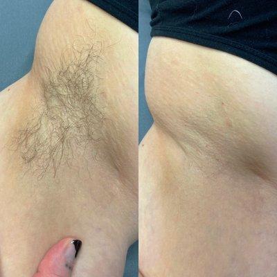 Underarm Wax