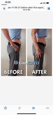 Cryo Body Sculpting and Cryo Body slimming