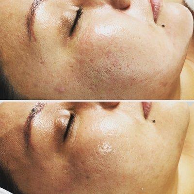 Deep pore treatments