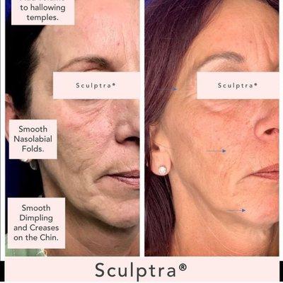 There is no other injectable filler that offers the global comprehensiveness that Sculptra® has to offer!