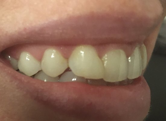 Right side before veneers- note the horrible bonding done on the lateral incisors done by another dentist