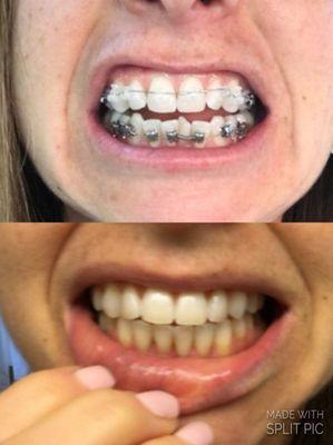 Braces on 4/4/16, jaw joint replacement 11/2/16, braces off 5/17/17!