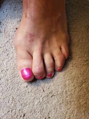 This supposed hammer toe correction has left me almost walking on my toe nail! Terrible