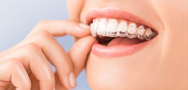 Invisalign in Midtown NYC - Dr. Alex Rubinov