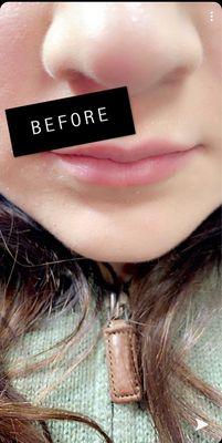 Needleless lip fillers