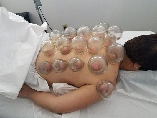 Cupping treatments