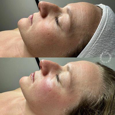 Before and after of one V-tox lift mask treatment