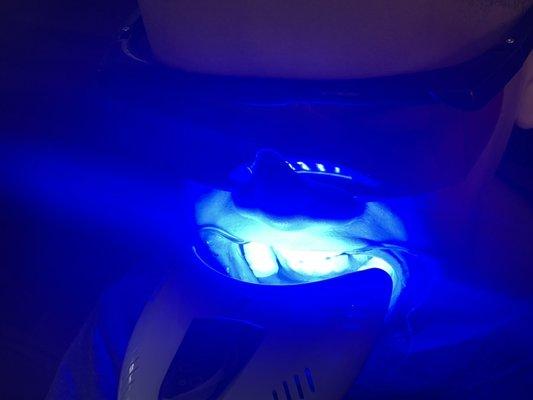 Teeth whitening session