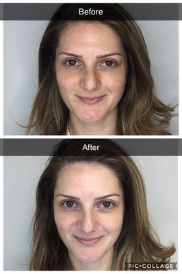 CryoFacials are amazing for special events, weddings, or simply putting your best face forward