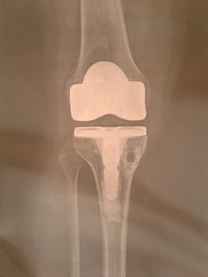 Front view , this is after a high tibia osteotomy 4 year ago. Look closely you can see how nicely Dr. Placed prosthetic.