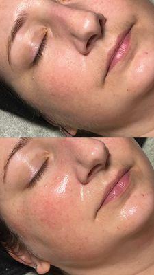 Results after Dermaplaning Facial - all dead surface cells and peach fuzz is gone!!