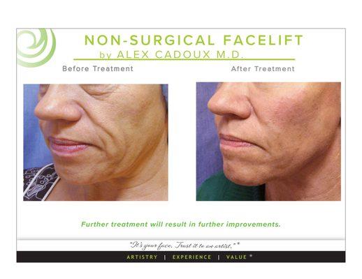 Stunning Non-Surgical Face Lift by Dr.Cadoux. Results are gradual, natural and long-lasting.