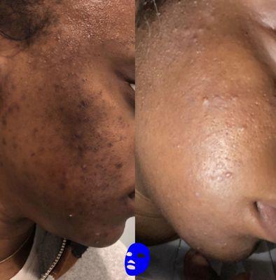 Custom Chemical Peel Transformation (Left Photo- before, Right Photo- after)