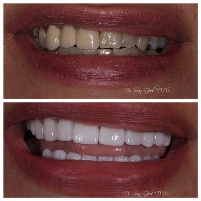 Before and after of 18 natural porcelain veneers