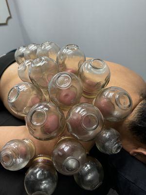 Cupping Therapy for pain release