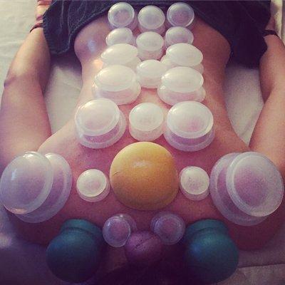 Cupping Therapy