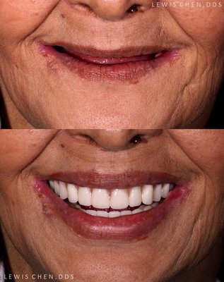 Dentures with Implants