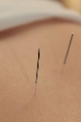 Acupuncture