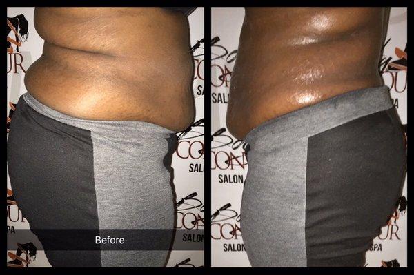 Before and After Body Contour Slimming Treatment