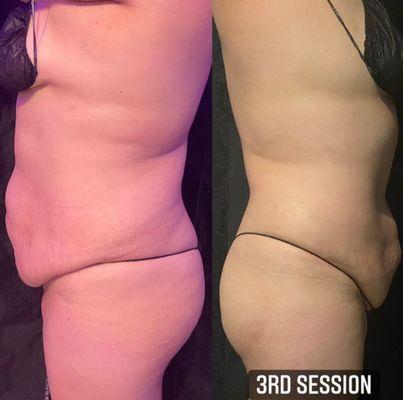 Body contouring After three sessions