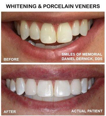 Only two veneers were needed after whitening and orthodontic treatment.