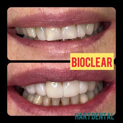 Dr Iwona can transform your teeth in ONE DAY with Bioclear restorations. Consultations are free!