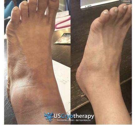 Which ankle do YOU prefer? Before and After 2 Localized Treatments