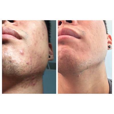 Before and after 8 weekly Micro-benefit Peels