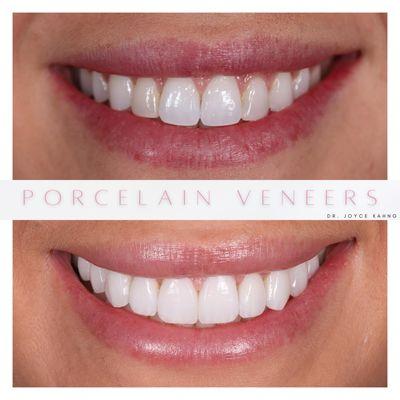 10 porcelain veneers to create a brighter and more full smile