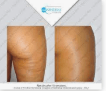 Cellulite Reduction with Endosphères Therapy