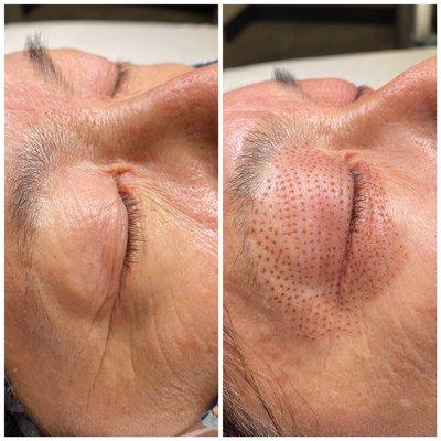 3 eye combo fibroblast skin tightening