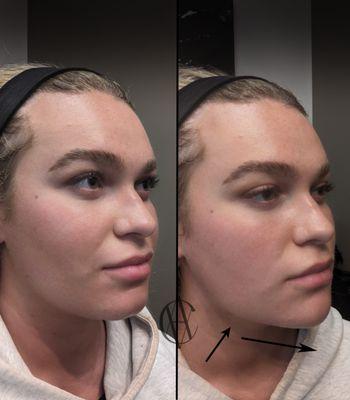 Jawline Filler + Chin Filler Before and After