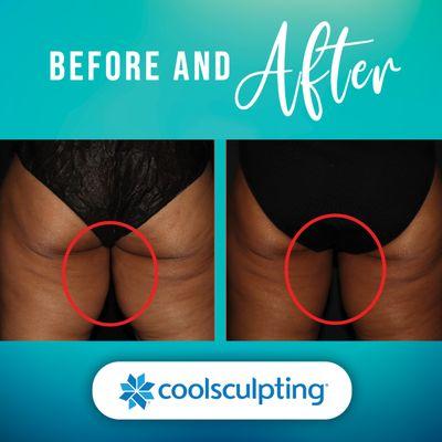 Achieve slimmer and tighter thighs with the latest CoolSculpting Elite!