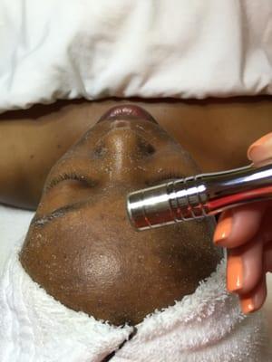 Microdermabrasion