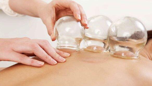 Cupping is great for back pain