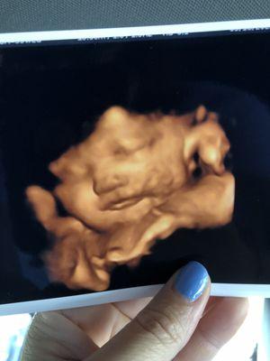 Ultrasound photo