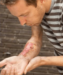 Burn Injuries