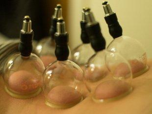 Cupping helps to reduce stagnation by bringing blood flow to an area that is painful or lacks range of motion!