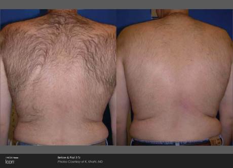 Hair removal before and after