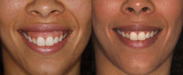 Before & After  Botox Treatment for Gummy Smile