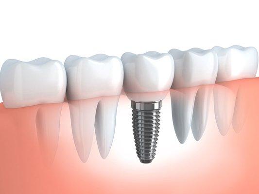 Looking for a better solution than dentures? Dental Implants by Comfy Dental Group could be your best choice for a perfect smile!